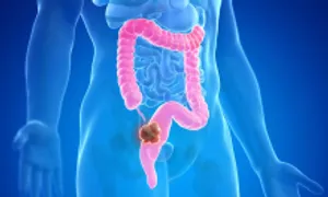 Cô gái 25 tuổi phát hiện ung thư từ triệu chứng quen thuộc Cô gái 25 tuổi phát hiện ung thư từ triệu chứng quen thuộc